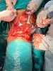 Demonstration of Amputation surgery